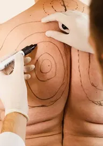 Pre-Surgery Marking